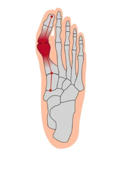 Hallux valgus Soft Bandage